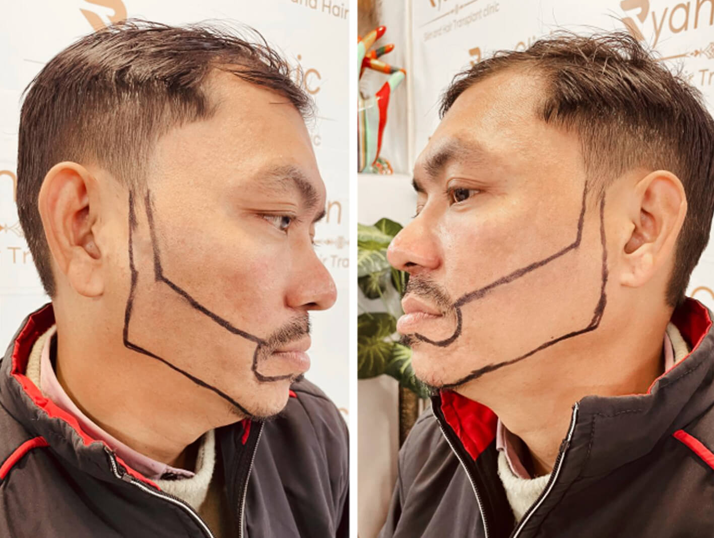 Beard transplant before after